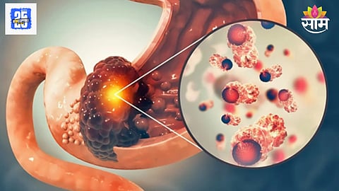 Stomach Cancer Early Symptoms