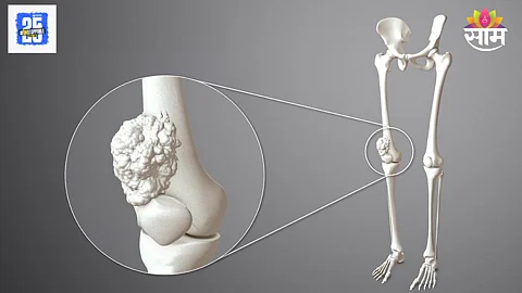 Bone cancer symptoms