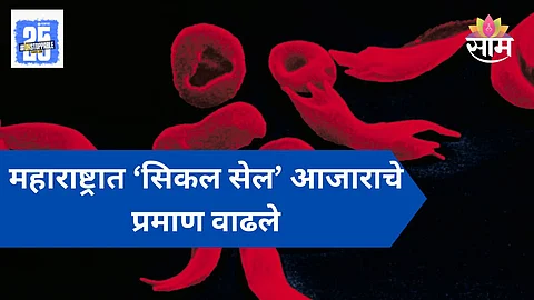Sickle Cell Disease