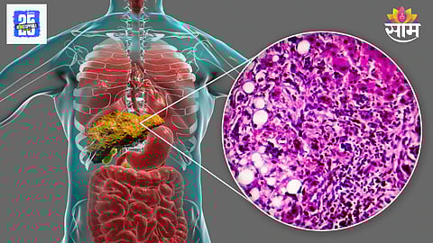 Fatty liver Ayurvedic treatment