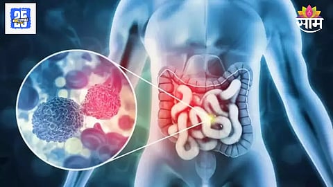 Early stomach cancer symptoms