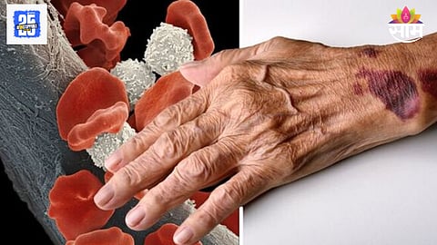 Symptoms of Blood Cancer During Night Time