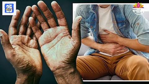 Signs of liver disease on hands