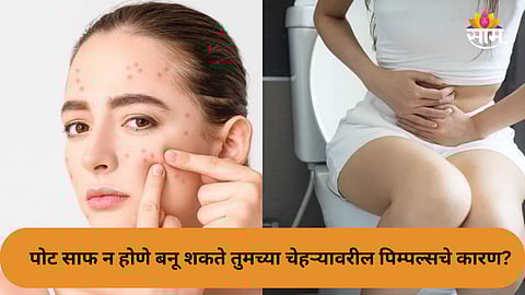 How constipation leads to acne and skin problems