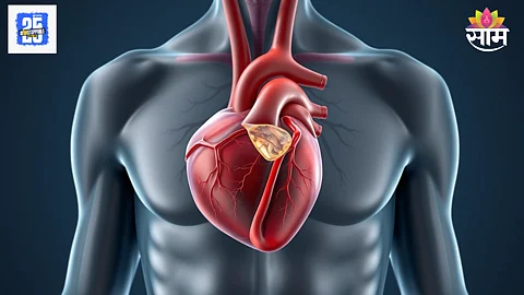 What Is a Silent Heart Attack