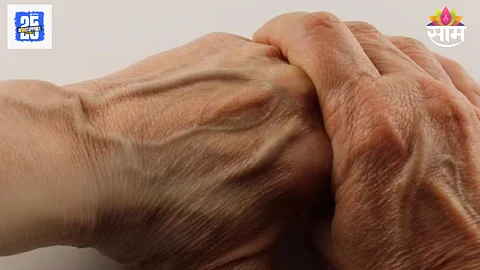 Swollen veins in hands