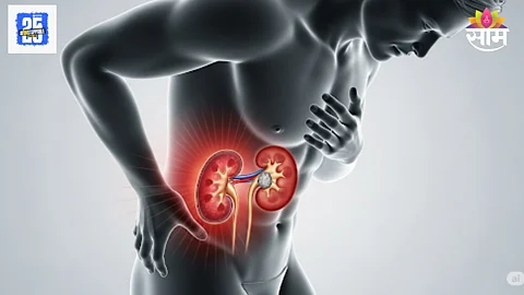 Early signs of kidney stones