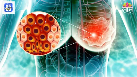 Cancer progression