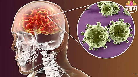 Meningitis Symptoms