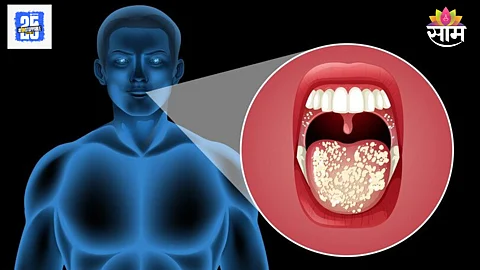Oral cancer