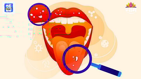 Early signs of oral cancer