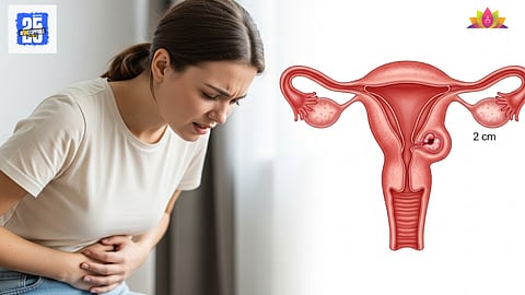 Uterine Cyst
