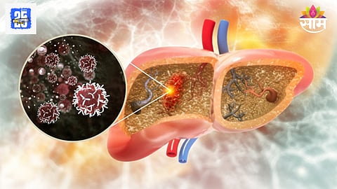 Liver cancer pain location