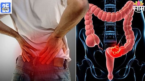 bowel cancer prevention