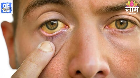 eye signs of cholesterol