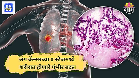 Lung cancer symptoms