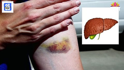 Early signs of liver damage on skin