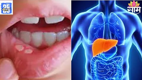 mouth burning causes