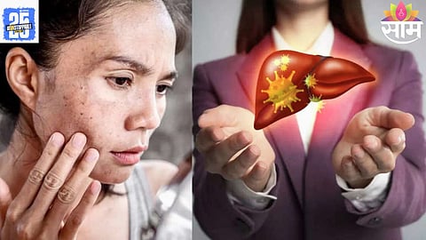 Liver Symptoms On Skin