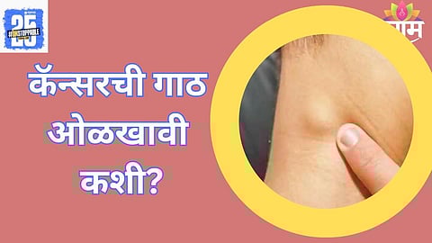 Benign Vs Cancer Lump