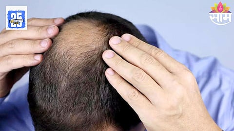 Hair Fall Causes: केस गळती वाढतेय? असू शकते 'या' व्हिटॅमिन्सची कमतरता, आजपासून घ्या असा आहार