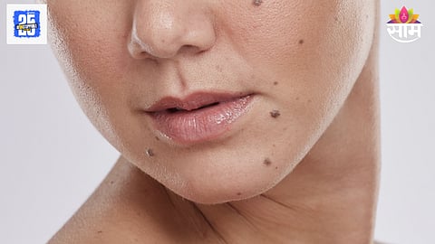 face mole meaning