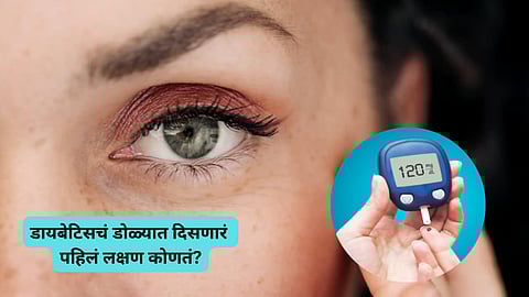 Diabetes First Symptom in Eyes