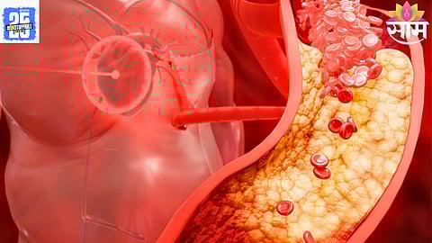 Cholesterol Diet Mistakes