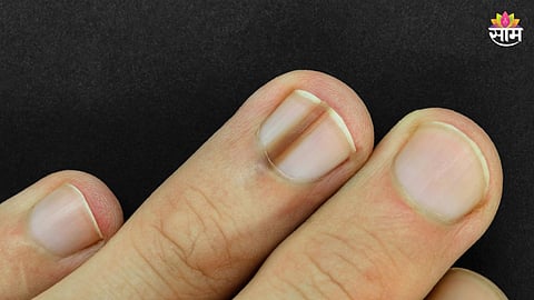 Fingernail black line cancer symptom