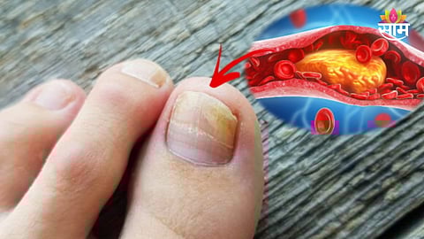 cholesterol symptoms in nails