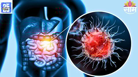 colorectal cancer under 50