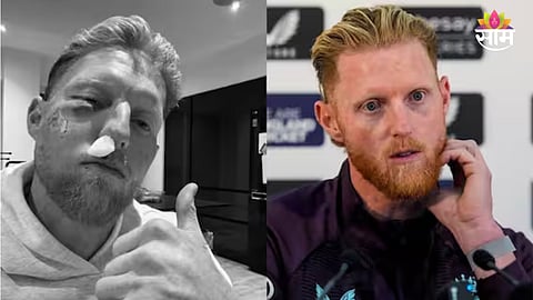 Ben Stokes facial injury