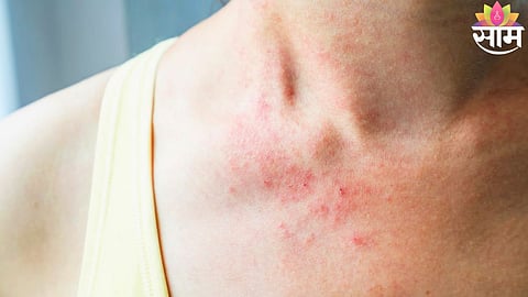 Persistent Itching and Cancer Symptoms