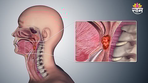 Symptoms of throat cancer