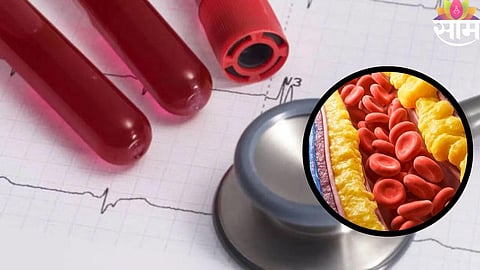 ApoB test importance