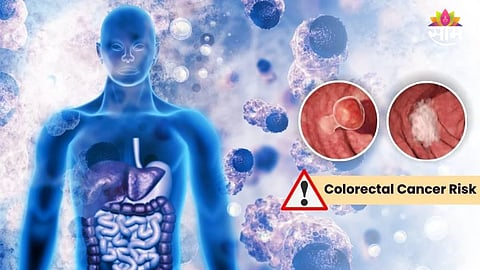 Can Microplastics Cause Colon Cancer