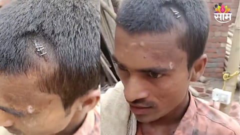 Stapler pins treatment