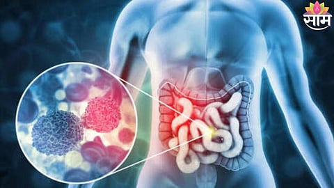 Colon Cancer Awareness