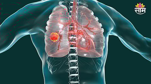 Lung cancer symptoms