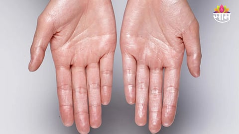 why do my hands sweat excessively