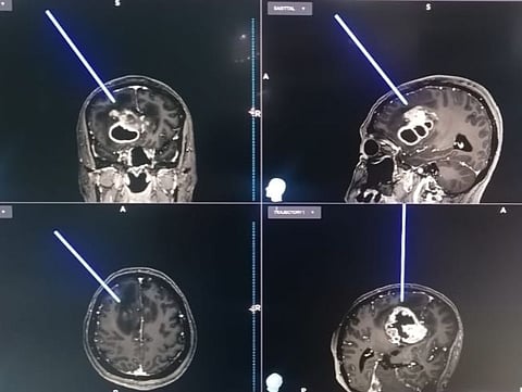 أول عملية جراحية بقسم المخ والأعصاب بمدينة الملك سلمان الطبية