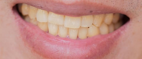 اصفرار الأسنان.. 6 أسباب غير مألوفة وهذه طرق تجنبها