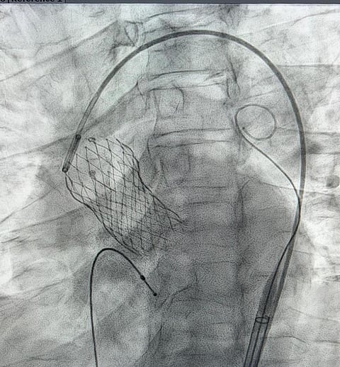 في "قلبي".. قسطرة ناجحة لسبعينية لتغيير الصمام الأورطي بالقسطرة بدلاً من الجراحة