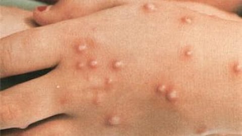 الإمارات تسجل 3 إصابات جديدة بجدري القردة