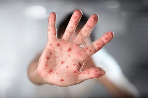 الخطر المحتمل.. مشاورات عالمية لوضع مخطط لمواجهة جدري القرود