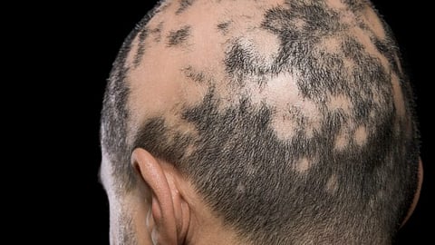 "الغذاء والدواء" الأمريكية توافق على أول علاج لداء الثعلبة