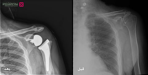 إجراء أول عملية زراعة مِفْصل صناعي "معكوس" للكتف