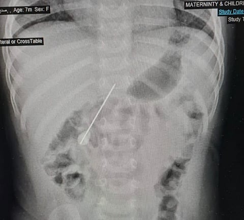 فريق طبي ينقذ "رضيعة أمريكية" ابتلعت إبرة