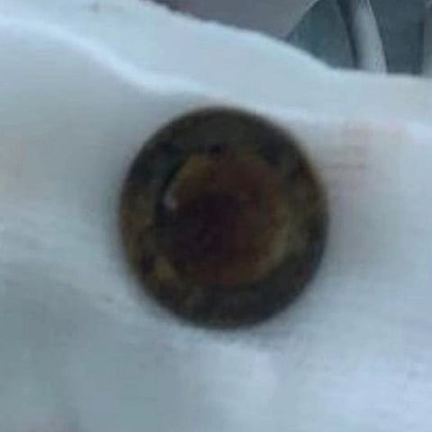 فريق طبي بجازان ينقذ طفلاً ابتلع قطعة نقود