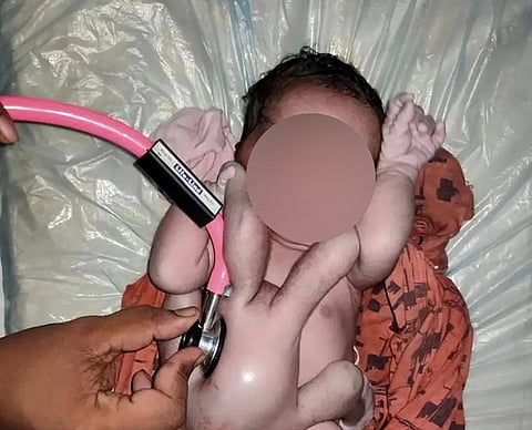 الناس تتوافد لرؤية "المعجزة" والعلم يفسر.. شاهد: طفلة بـ4 أذرع و4 أرجل